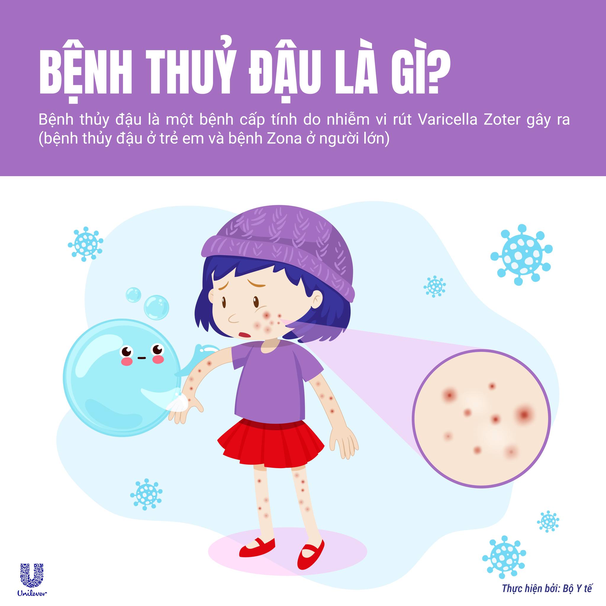 BỆNH THỦY ĐẬU NHỮNG ĐIỀU CẦN BIẾT